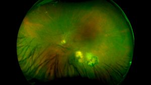 uveitis infecciosa toxoplasmosi