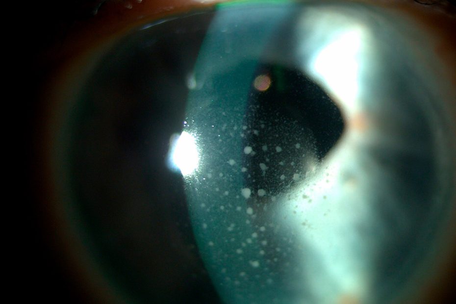 Uveitis herpetica